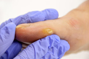 Callus Treatment