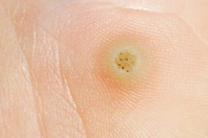 Verrucae Treatment at The Foot Health Clinic