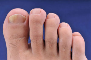 Fungal Nail and Skin Infection treatment at The Foot Health Clinic