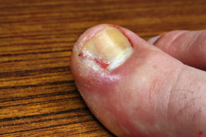 Ingrown Toenails - treatment available at The Foot Clinic Dublin