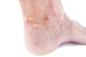 Treatment for Foot Wounds, Ulcerations and Blisters