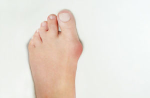Treatment for bunions at The Foot Health Clinic
